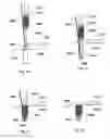 Fig. 32 - Implant placement systems, devices and methods