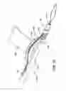 Fig. 09 - Knotless suture anchor and driver