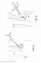 Fig. 03 - Method and apparatus for occluding a blood vessel
