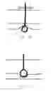 Fig. 80 - Method and apparatus for occluding a blood vessel