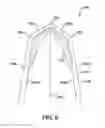 Fig. 09 - SURGICAL CLIP HAVING COMPLIANT PORTION