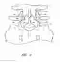 Fig. 12 - Method and apparatus for spinal stabilization