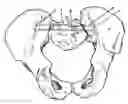 Fig. 01 - Method for Minimally Invasive Treatment of Unstable Pelvic Ring Injuries with an Internal Posterior Iliosacral Screw and Bone Plate