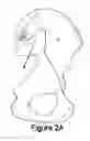 Fig. 03 - Method for Minimally Invasive Treatment of Unstable Pelvic Ring Injuries with an Internal Posterior Iliosacral Screw and Bone Plate