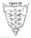 Fig. 04 - Method for Minimally Invasive Treatment of Unstable Pelvic Ring Injuries with an Internal Posterior Iliosacral Screw and Bone Plate