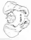 Fig. 05 - Method for Minimally Invasive Treatment of Unstable Pelvic Ring Injuries with an Internal Posterior Iliosacral Screw and Bone Plate