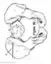Fig. 06 - Method for Minimally Invasive Treatment of Unstable Pelvic Ring Injuries with an Internal Posterior Iliosacral Screw and Bone Plate