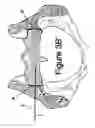 Fig. 07 - Method for Minimally Invasive Treatment of Unstable Pelvic Ring Injuries with an Internal Posterior Iliosacral Screw and Bone Plate