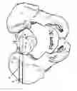 Fig. 08 - Method for Minimally Invasive Treatment of Unstable Pelvic Ring Injuries with an Internal Posterior Iliosacral Screw and Bone Plate