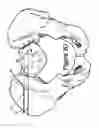 Fig. 09 - Method for Minimally Invasive Treatment of Unstable Pelvic Ring Injuries with an Internal Posterior Iliosacral Screw and Bone Plate