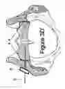 Fig. 10 - Method for Minimally Invasive Treatment of Unstable Pelvic Ring Injuries with an Internal Posterior Iliosacral Screw and Bone Plate