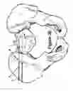 Fig. 11 - Method for Minimally Invasive Treatment of Unstable Pelvic Ring Injuries with an Internal Posterior Iliosacral Screw and Bone Plate