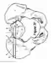Fig. 13 - Method for Minimally Invasive Treatment of Unstable Pelvic Ring Injuries with an Internal Posterior Iliosacral Screw and Bone Plate