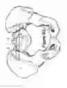 Fig. 14 - Method for Minimally Invasive Treatment of Unstable Pelvic Ring Injuries with an Internal Posterior Iliosacral Screw and Bone Plate