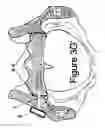 Fig. 15 - Method for Minimally Invasive Treatment of Unstable Pelvic Ring Injuries with an Internal Posterior Iliosacral Screw and Bone Plate