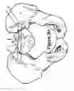 Fig. 16 - Method for Minimally Invasive Treatment of Unstable Pelvic Ring Injuries with an Internal Posterior Iliosacral Screw and Bone Plate
