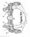 Fig. 17 - Method for Minimally Invasive Treatment of Unstable Pelvic Ring Injuries with an Internal Posterior Iliosacral Screw and Bone Plate