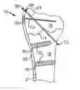 Fig. 01 - Fracture fixation system including locking cap and wire