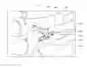 Fig. 01 - Bone plate for reducing angular bone deformity and method of using