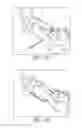 Fig. 17 - Bone plate for reducing angular bone deformity and method of using