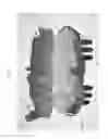 Fig. 07 - Method for manufacturing surgical guide and crown, abutment in mouth for dental implant