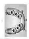 Fig. 09 - Method for manufacturing surgical guide and crown, abutment in mouth for dental implant