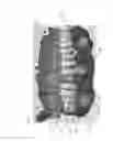 Fig. 10 - Method for manufacturing surgical guide and crown, abutment in mouth for dental implant