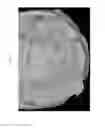 Fig. 12 - Method for manufacturing surgical guide and crown, abutment in mouth for dental implant