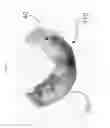 Fig. 17 - Method for manufacturing surgical guide and crown, abutment in mouth for dental implant