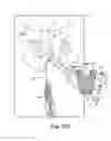 Fig. 24 - Method of treating urinary incontinence