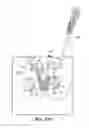 Fig. 28 - Method of treating urinary incontinence