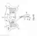 Fig. 65 - Method of treating urinary incontinence