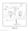 Fig. 70 - Method of treating urinary incontinence