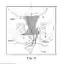 Fig. 72 - Method of treating urinary incontinence