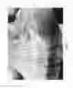 Fig. 05 - Vascular casted prostheses and methods of forming same for treating biological tissue