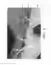 Fig. 08 - Vascular casted prostheses and methods of forming same for treating biological tissue