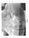 Fig. 10 - Vascular casted prostheses and methods of forming same for treating biological tissue