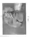Fig. 11 - Vascular casted prostheses and methods of forming same for treating biological tissue