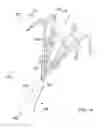 Fig. 05 - Vessel occlusion devices, kits and methods