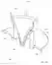 Fig. 20 - Vessel occlusion devices, kits and methods