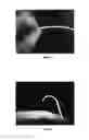 Fig. 03 - Delivery method for biodegradable stents