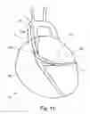 Fig. 15 - Graft devices and methods of fabrication