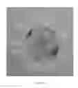 Fig. 11 - Accommodative intraocular lens and method of improving accommodation