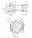 Fig. 02 - Everting transcatheter valve and methods
