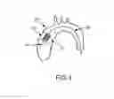 Fig. 06 - Everting transcatheter valve and methods