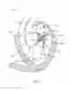 Fig. 02 - Sequentially deployed transcatheter mitral valve prosthesis
