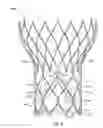 Fig. 07 - Valve cuff support