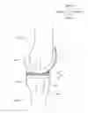 Fig. 01 - Artificial knee joint implant