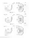 Fig. 13 - Artificial knee joint implant