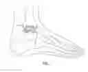 Fig. 02 - Attachments for orthopedic implants